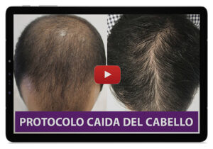 Terapia con Imanes Caida del Cabello